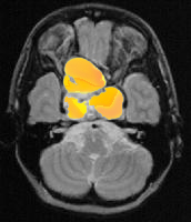 MRI scan of rathke's cleft cyst