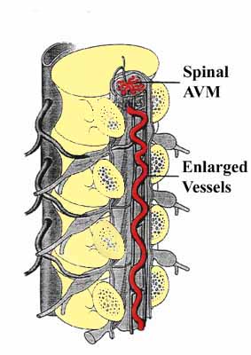 Spinal AVM