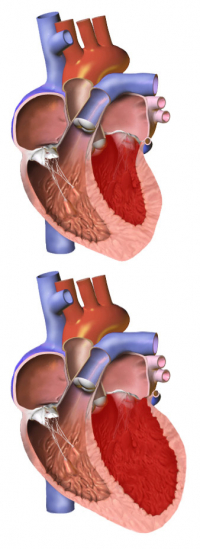 Congestive heart failure can lead to a dangerous condition in which the heart becomes enlarged. In this graphic, the heart on the bottom has an enlarged ventricle. A normal heart is seen above. (Image from Blausen Medical Communications via Wikimedia Commons)