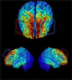 An MRI-derived model of electric current flow in an individual’s brain. Red and blue outlines represent the size and position of electrodes placed on the scalp to deliver transcranial direct current stimulation to the brain. Electrical current is injected at the location of the red outline and returned at the location of the blue outline during stimulation.