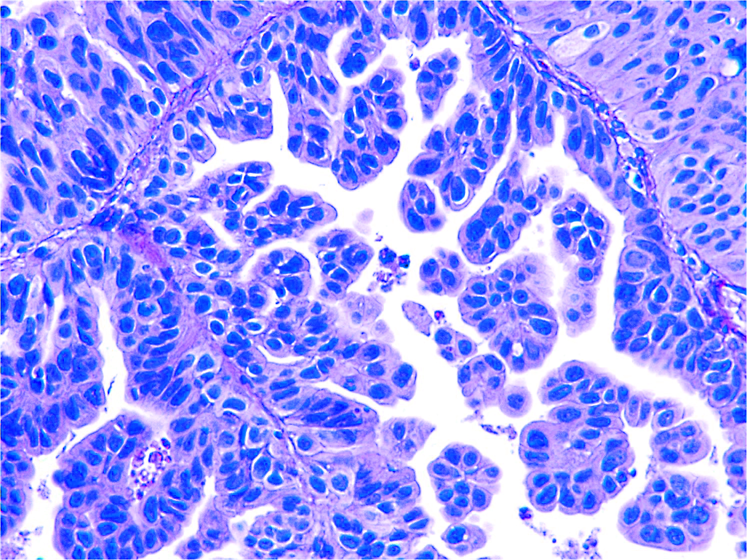 Bladder cancer cells