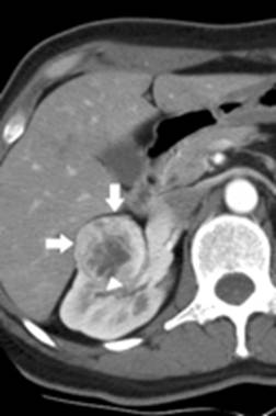 Figure 1c. Examples of CT scans demonstrating small kidney tumors removed by robotic partial nephrectomy