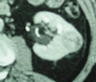 Figure 1d. Examples of CT scans demonstrating small kidney tumors removed by robotic partial nephrectomy