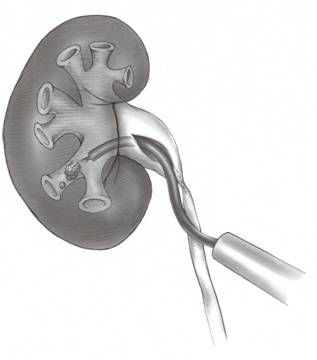 Figure 6. Flexible telescope is inserted at the time of robotic pyeloplasty to retrieve stones within the kidney.