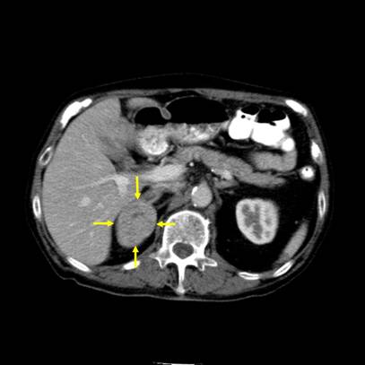 Figure 1. Examples of CT scans demonstrating adrenal tumors removed by robotic adrenalectomy.