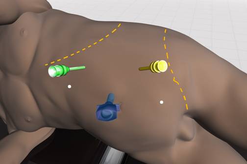 Figure 2. Trocar configuration for laparoscopic and robotic adrenalectomy (courtesy of Intuitive Surgical Inc, Sunnyvale, CA).