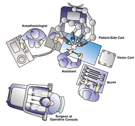 Figure 4. Operating room configuration for left robotic adrenalectomy (courtesy of Intuitive Surgical Inc, Sunnyvale, CA).
