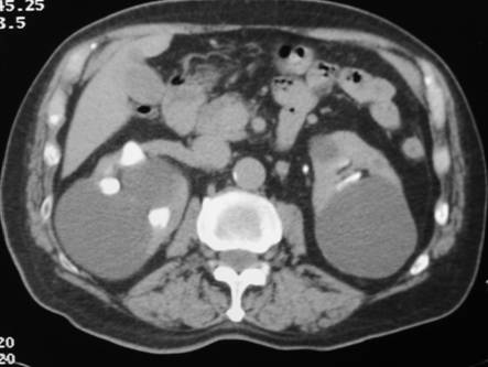 Figure 1. CT scan demonstrating bilateral symptomatic renal cysts that were treated by laparoscopic renal cyst ablation.