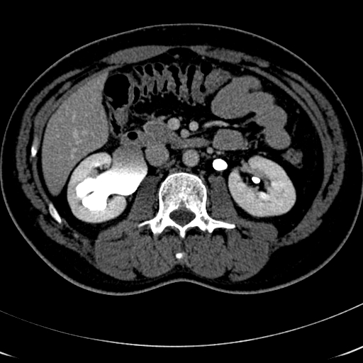 Figure 1. CT scan demonstrating a right UPJ obstruction with dilation of the renal pelvis which was repaired by robotic pyeloplasty.