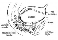 robotic prostatectomy clip image010