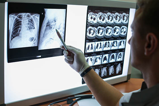 When it comes to those checkups, there hasn’t been a widely accepted screening tool available for early-stage lung cancer until recently. Far too often, regular chest X-rays have missed lung tumors during the most beneficial time to be a reliable method for detection.